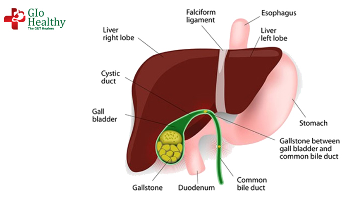 Gallstones | Gallbladder Stone Surgery | Laparoscopic Gallbladder Surgery